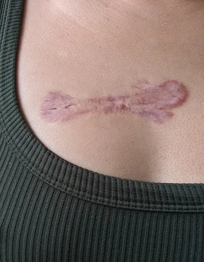 This is another example of a hypertrophic scar on the chest. Treating such scars early can lead to better outcomes. My methods focus on reducing the scar's thickness and redness to make it less noticeable.