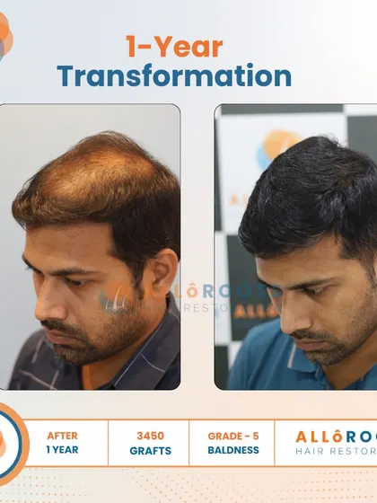 This is a one-year transformation for a Grade 5 baldness case, achieved with 3450 grafts. The before and after photos from various angles show a comprehensive restoration of the scalp, resulting in a full and natural look.