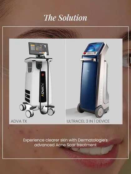 My clinic utilizes advanced technology like the AdvaTx and Ultracel devices to provide cutting-edge solutions for acne scar treatment and skin tightening.