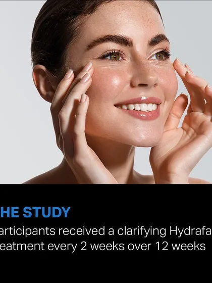 A clinical study on HydraFacial involved participants receiving a clarifying treatment every 2 weeks over a 12-week period to measure its effectiveness on acne.