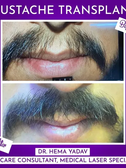 A patchy mustache can be easily corrected. Here you can see a clear before-and-after of a mustache transplant, where we significantly increased the density and created a fuller, more defined shape. This is a permanent solution for a stronger look.