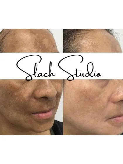 See the dual-action results on both the forehead and cheeks. This treatment effectively reduces widespread pigmentation for a more uniform skin tone.