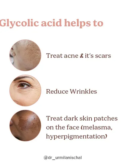 This infographic explains the many benefits of Glycolic Acid. It is a powerful AHA that helps treat acne and scars, reduce wrinkles, and fade dark patches like melasma by effectively exfoliating the skin and promoting cell turnover.