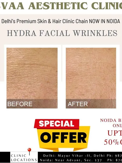 This before and after shows how our HydraFacial treatment can diminish the appearance of fine wrinkles. The procedure hydrates the skin, leading to a smoother and plumper texture.