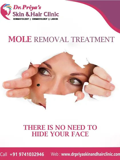 Moles can be a cosmetic concern for many individuals. I perform mole removal using advanced techniques like CO₂ laser to ensure the procedure is safe, effective, and leaves behind minimal marking for a natural-looking result.