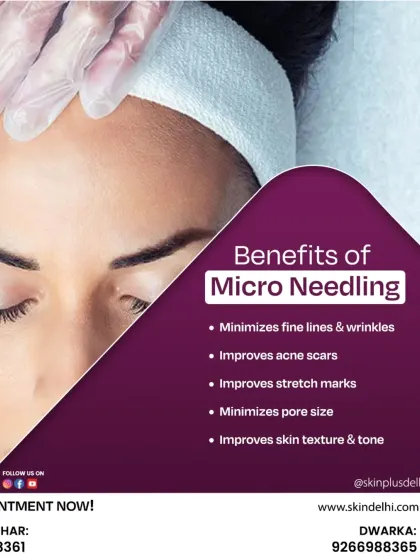 This graphic summarizes the key benefits of microneedling. The treatment is highly effective for minimizing fine lines, improving acne scars and stretch marks, reducing pore size, and enhancing overall skin texture and tone.