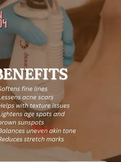 This image lists the many benefits of our resurfacing treatments, which are excellent for acne scars. They soften fine lines, lessen acne scars, improve texture issues, and balance uneven skin tone.
