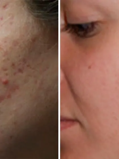 Here, the focus was on treating the red, inflamed marks left behind by acne. We used specific treatments to target vascular redness and promote faster healing, leading to a calmer and more even-toned appearance.