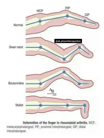 Rheumatoid arthritis can cause specific deformities in the finger joints. This diagram illustrates conditions like Swan neck and Boutonnière deformities, which we manage with specialized hand therapy to maintain function.