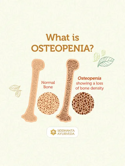Osteopenia is a precursor to osteoporosis, indicating a loss of bone density. This diagram clearly shows the difference between a normal bone and one with osteopenia, emphasizing the need for proactive care.