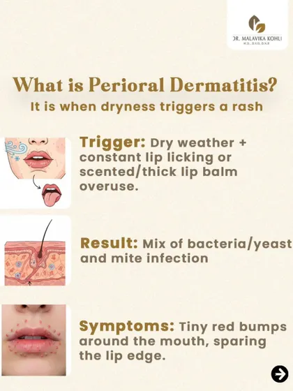 Perioral Dermatitis is often triggered by dryness combined with habits like constant lip licking or the overuse of thick, scented lip balms. The result is an inflammatory reaction involving a mix of bacteria, yeast, and mites, presenting as tiny red bumps around the mouth.