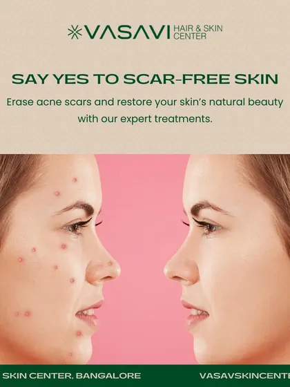 The goal for every patient is to achieve scar-free skin and restore its natural beauty. This image represents the journey from active breakouts and resulting marks to a clear, smooth complexion. My expert treatments are designed to manage acne and effectively erase the scars it leaves behind.