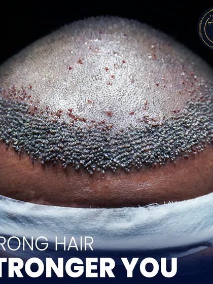 This is where science meets style. A detailed view of newly implanted hair follicles, showcasing the meticulous process of high-density hair restoration.