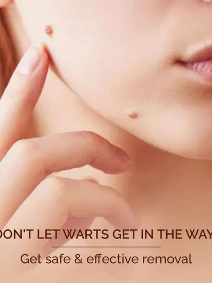 Warts are common viral growths that can be safely and effectively removed in a clinical setting. I offer several treatment options, including cryotherapy and laser removal.