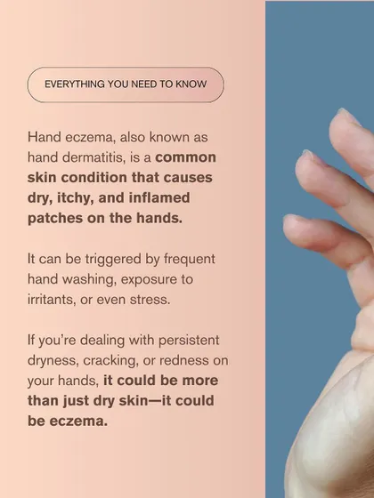 Also known as hand dermatitis, hand eczema is a common condition that causes inflammation and irritation. It can be triggered by frequent hand washing, stress, or exposure to certain substances.
