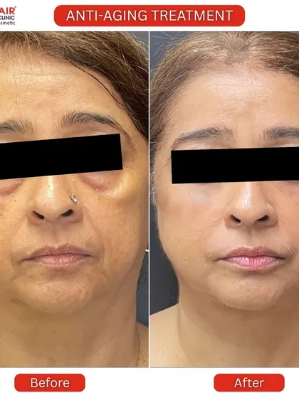 This is the power of a personalized anti-aging plan. This before and after showcases a comprehensive treatment that visibly reduced under-eye hollows, softened deep lines, and restored a firmer, more youthful contour to the face for a naturally refreshed appearance.
