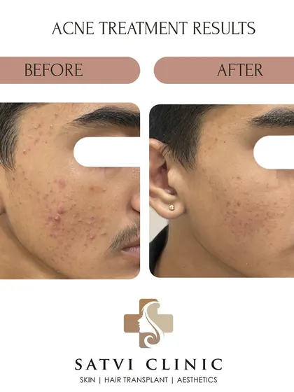 This is a clear example of how we can manage and control teenage acne. With a proper diagnosis and a consistent, simple routine, we were able to reduce active breakouts and inflammation, preventing future scarring.