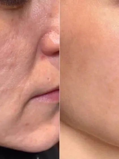 A visible reduction in both scar depth and overall skin roughness. This patient's journey involved a series of CO2 laser sessions, each one progressively smoothing the skin's landscape and improving its light-reflecting quality for a healthier glow.