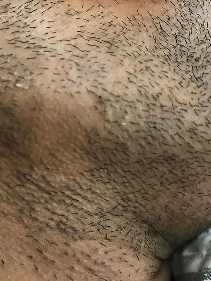 We also treat medical conditions that cause facial hair loss. This is a close up view of Alopecia Areata in the beard area, a condition we regularly diagnose and create personalized treatment plans for at our clinic.