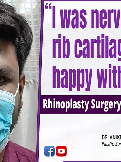 This patient was nervous about using rib cartilage for his rhinoplasty but is now happy with the result. Using a patient's own tissue is our preferred method for safety and natural, long-lasting outcomes.