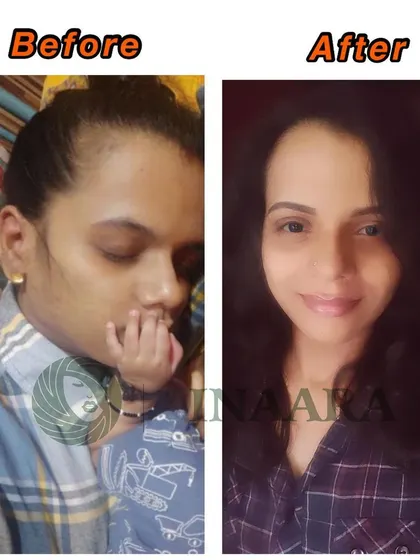 Postpartum hair fall can be distressing, but you don't have to go through it alone. This is a real before and after from one of my dear clients, showing how my products helped her regain hair density and confidence after childbirth.