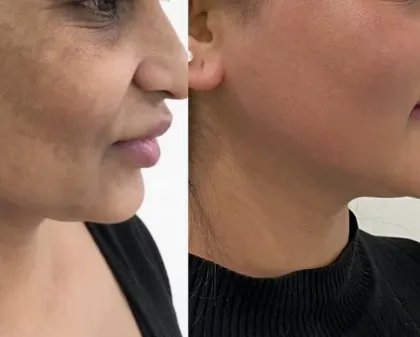 This patient's transformation shows a remarkable reduction in widespread facial pigmentation. Her skin now looks healthier, more even, and has a natural glow that was previously hidden by the dark patches.
