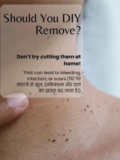 I cannot stress this enough: do not attempt to cut or tie off skin tags at home. The risk of bleeding, infection, and scarring is very high. Professional removal is the only safe option.