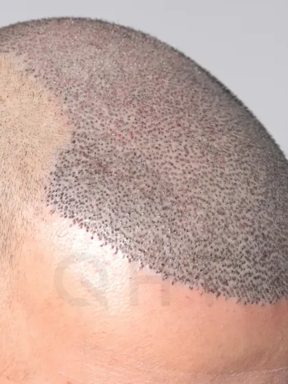 A close-up of graft placement for a Norwood Grade 6 case. 6000 grafts were implanted in a single session for full coverage.