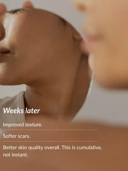 Microneedling results are cumulative, not instant. Weeks after a session, clients notice significant improvements in skin texture, softer scars, and better overall skin quality as collagen rebuilds.