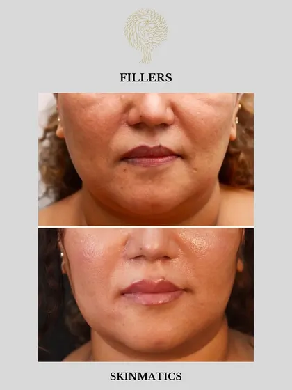 A second view of a full-face rejuvenation using fillers. Notice the restored volume in the mid-cheek and the softening of nasolabial folds, which contributes to a more youthful and refreshed appearance.
