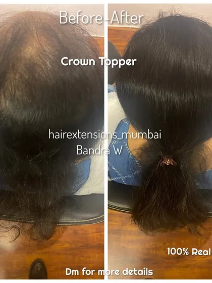 Another successful crown topper application. The topper provides natural-looking volume and coverage, completely concealing the thinning area.