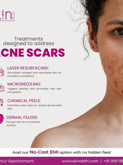 This infographic outlines our targeted treatments for acne scars. We offer solutions like laser resurfacing, microneedling, chemical peels, and dermal fillers to stimulate collagen and promote smoother skin.