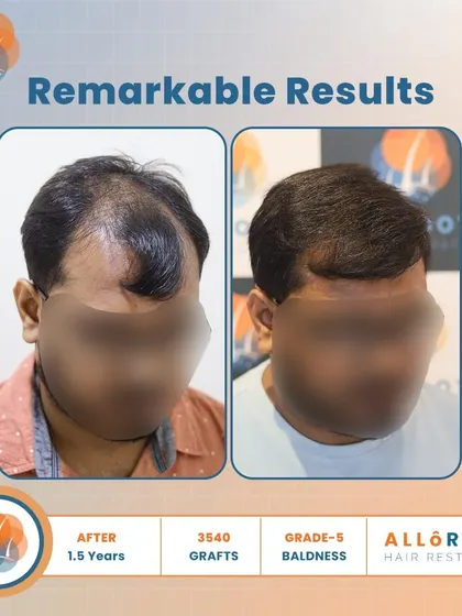 Remarkable results after 1.5 years for a Grade 5 baldness case. Using 3540 grafts, we achieved a dense and natural-looking outcome, as shown in these detailed before-and-after shots.