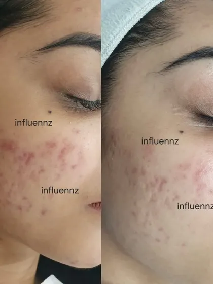 A close-up view of how targeted acne treatment effectively reduces both breakouts and the red marks they leave behind, leading to healthier-looking skin.