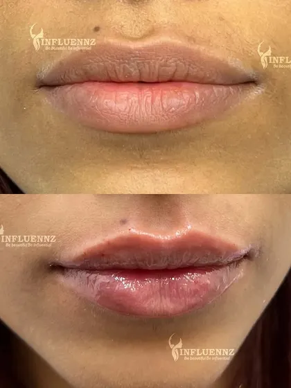 This is a great example of how lip fillers can enhance your natural beauty. We added subtle volume and definition to create a balanced, hydrated, and youthful pout. The goal is always to refine, not to change your look entirely.