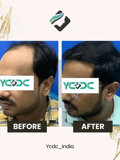 A side-view comparison of a hair transplant result. Notice the restored hairline and increased thickness, which frames the face and creates a more youthful appearance.