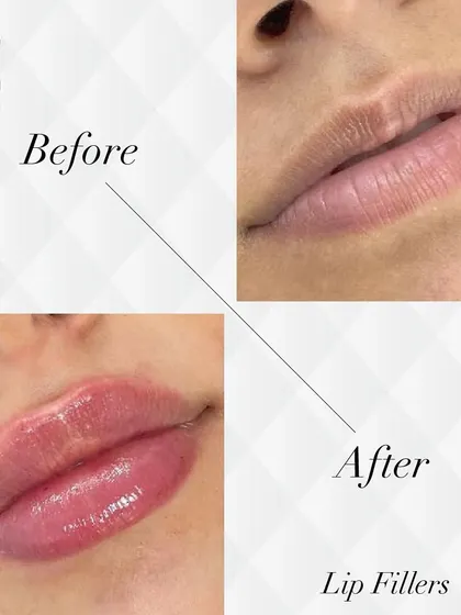 Here is a beautiful example of my lip filler work. I focus on enhancing the natural shape and restoring volume for a hydrated, balanced look, avoiding the overfilled or "duck" look.