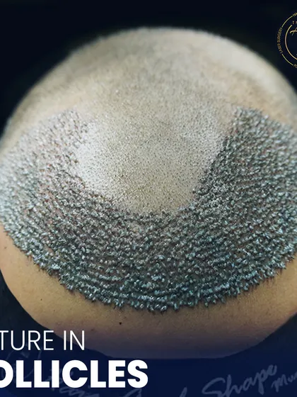 This is where science meets style. A detailed view of newly implanted hair follicles, showcasing the meticulous process of high-density hair restoration.