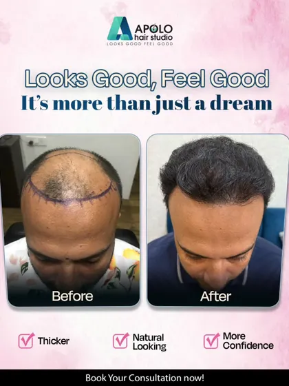 This is the result we strive for with every hair transplant. The goal is not just to add hair, but to restore a natural, thicker hairline that boosts your confidence and makes you feel good.