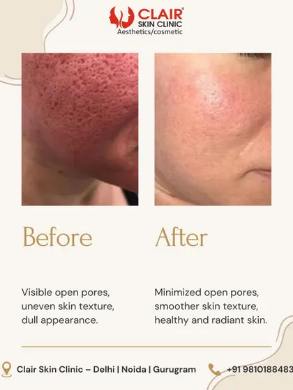Enlarged pores and rough texture can make skin appear dull. This before and after demonstrates how our treatments can refine the skin's surface, leading to visibly minimized pores and a smoother, more radiant complexion.