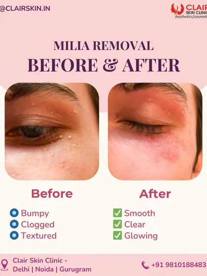 From bumpy and clogged to smooth and clear. This before and after highlights the effectiveness of our milia removal treatment. We safely extract these small cysts to reveal a glowing, even-textured skin surface.