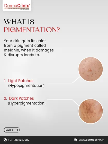 This graphic explains what pigmentation is, detailing how damaged melanin can lead to light patches (hypopigmentation) or dark patches (hyperpigmentation).