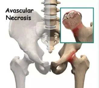 Avascular Necrosis (AVN) is a condition where bone tissue dies due to a lack of blood supply. Physiotherapy plays a crucial role in managing pain, improving mobility, and helping with recovery.
