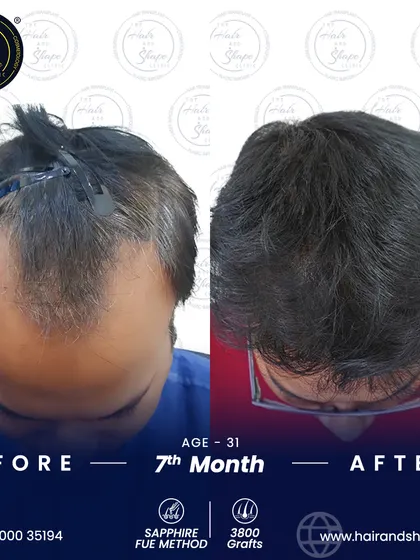 The view from above shows how the Sapphire FUE method effectively restored density across the top of the scalp, creating a full head of hair in just 7 months.