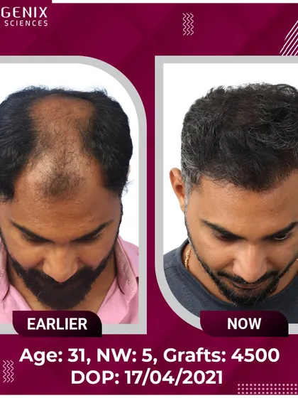 This 31-year-old patient's journey from Grade 5 hair loss to happiness with 4500 grafts.