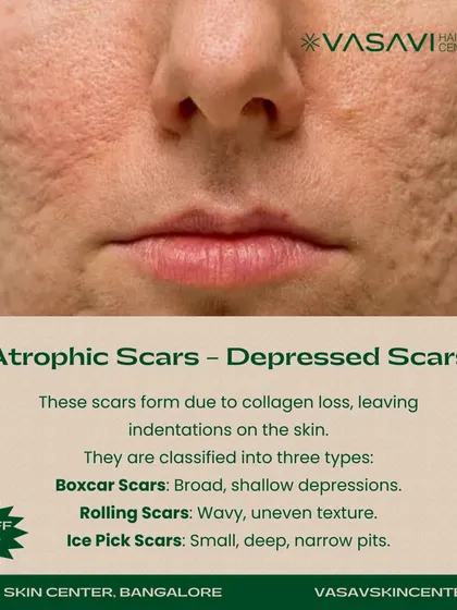 Atrophic scars, or depressed scars, form due to a loss of collagen during the healing process. This image shows a close-up of this scar type and further classifies them into boxcar, rolling, and ice pick scars, each with a unique shape and depth.