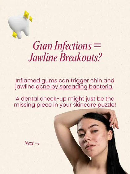 Could gum infections be the cause of your jawline breakouts? Inflamed gums can trigger chin and jawline acne by spreading bacteria. A dental check-up might be the missing piece in your skincare puzzle.