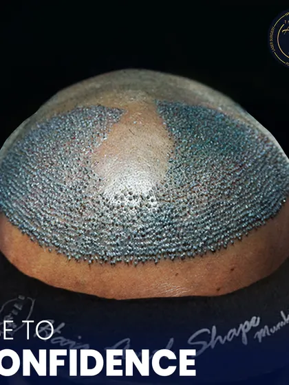 This is where science meets style. A detailed view of newly implanted hair follicles, showcasing the meticulous process of high-density hair restoration.