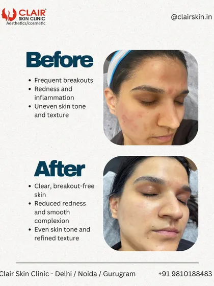 From inflamed, active breakouts to calm, clear skin. This before and after demonstrates our ability to manage frequent breakouts and reduce the associated redness and uneven texture for a smooth, healthy complexion.