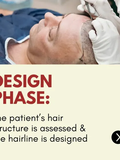The Design Phase: The first step is a detailed assessment of your hair structure and loss pattern to design a hairline that is both natural and meets your expectations.